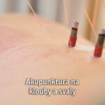 akupunktura na klouby a svaly