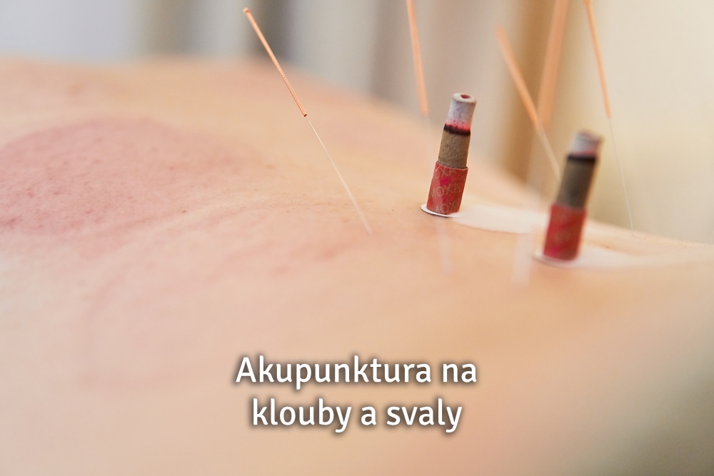 akupunktura na klouby a svaly